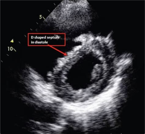 d shaped septum in systole.